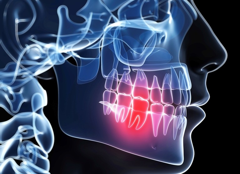 Sprawdzone domowe sposoby na ból zęba